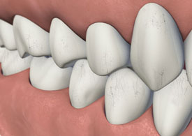 Teeth Crazelines