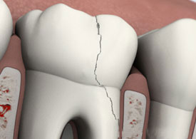 Fractured teeth
