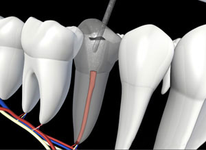 Removing fillings of tooth