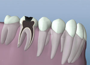 Root Canal Therapy Cleaned Canals