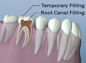 Root Canal Therapy Canal Filling
