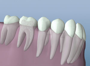 Root Canal Therapy Healed by Root Canal