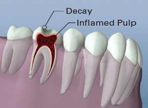 Tooth Inflammation Root Canal Therapy