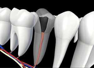 Root material placed into tooth
