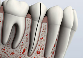 Cracked teeth example