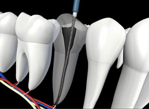 Tooth with canals cleaned
