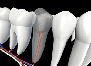 Tooth with inflamed tissue