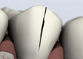 Close up cracked teeth example